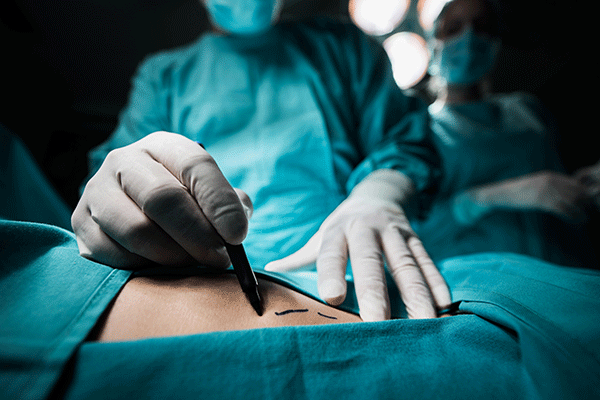 Imagem de um médico, no centro cirúrgico, desenhando traços com uma caneta preta no abdome do paciente.